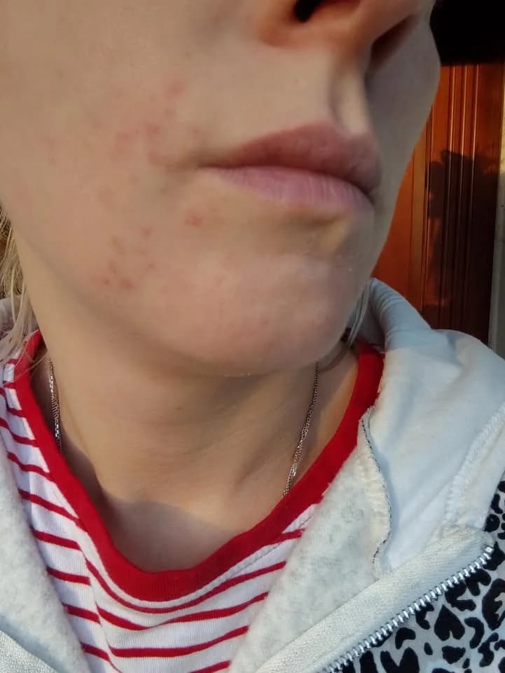 Aneta R. – před a po užívání ProBio 3D