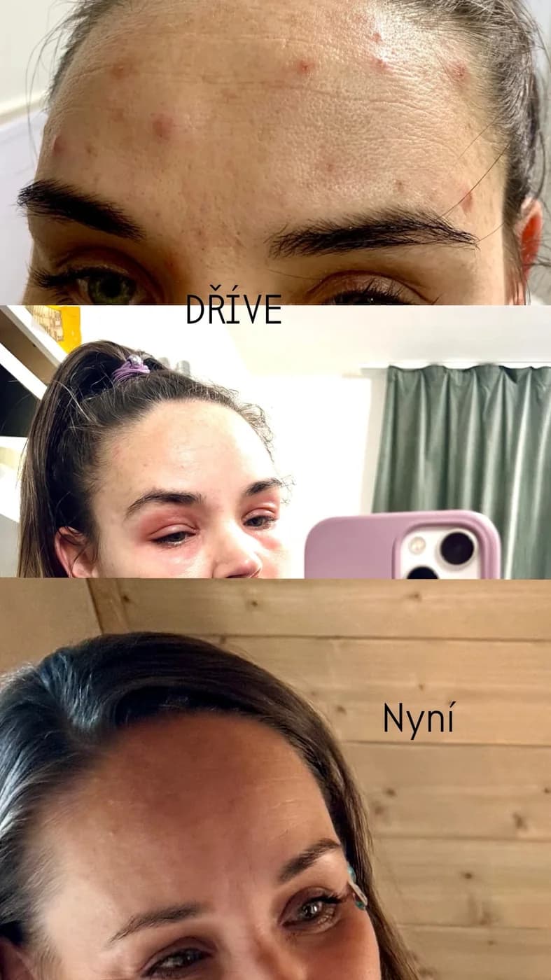 Leni – pleť před a po užívání ProBio 3D